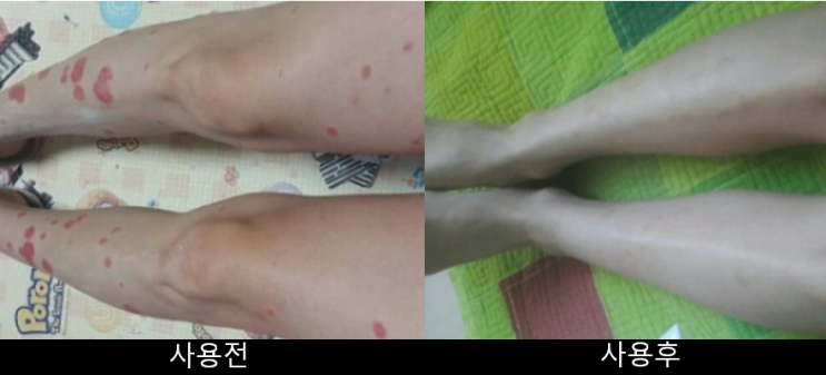  건선초기증상 2달동안 회복한 실제 후기입니다