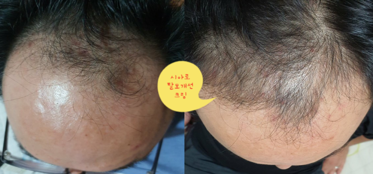  점점 늘어나는 탈모인구, 예방하는 방법 찾아보기
