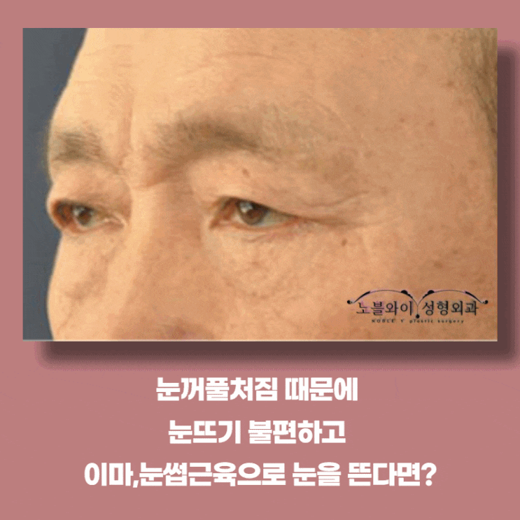  눈꺼풀처짐수술 하나인데 효과는 여러가지