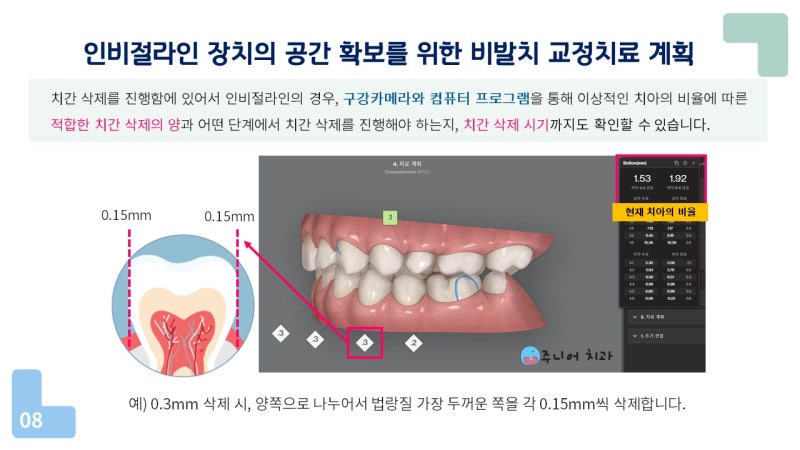 포천교정과는 다양한 교정기기를 보유하고 있어 선택의 폭이 넓습니다. 5