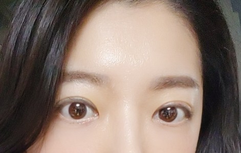  쌍꺼풀수술 붓기 빼기 절개 2주만에 뺀 방법 당귀수산 뉴베인