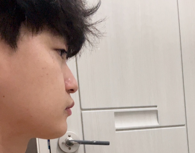  부산 남자 코수술, 코성형 21일차 리얼 후기! 코끝붓기,아바타 너무 걱정하지마세요(지금까지 사진 대공개)