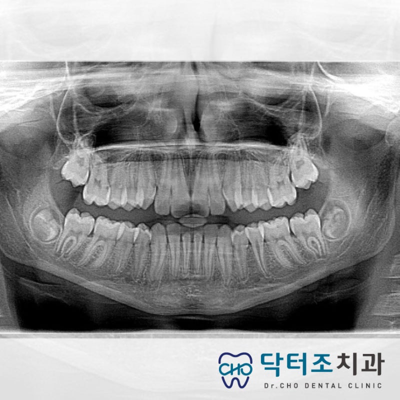 덕양구 사랑니 발치 신경에 가까운 매복치아 발치.고양시 치과 6