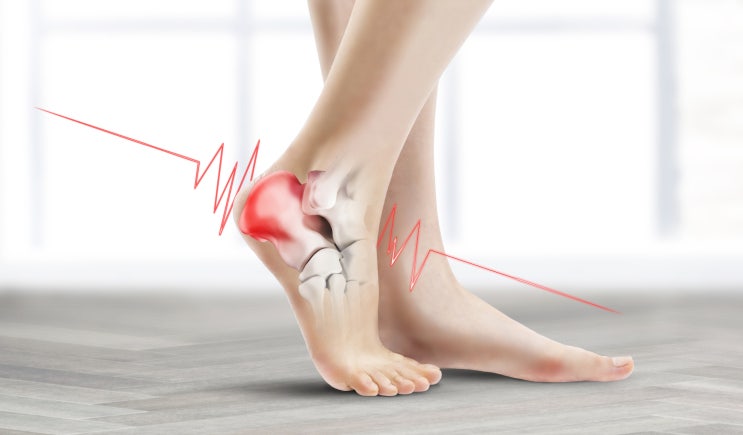  찌릿찌릿 발바닥 통증 족근관증후군 원인