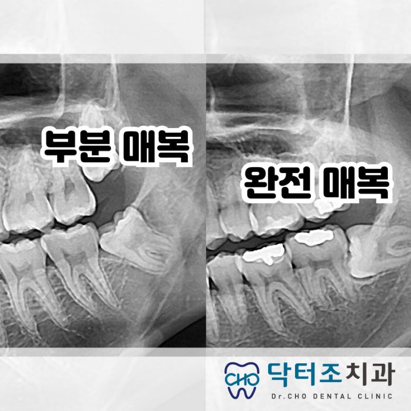 덕양구 사랑니 발치 신경에 가까운 매복치아 발치.고양시 치과 11
