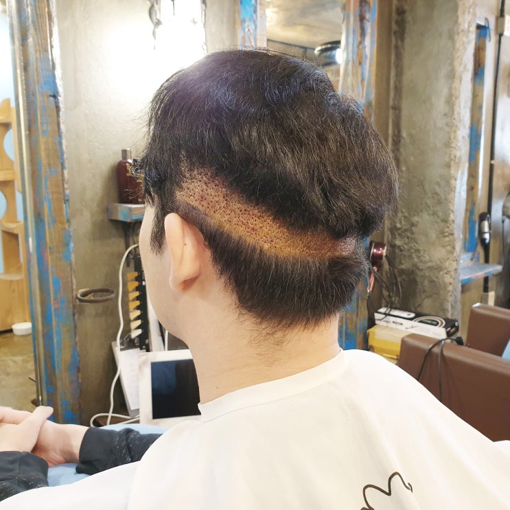  머리심기 후두부가 중요해요