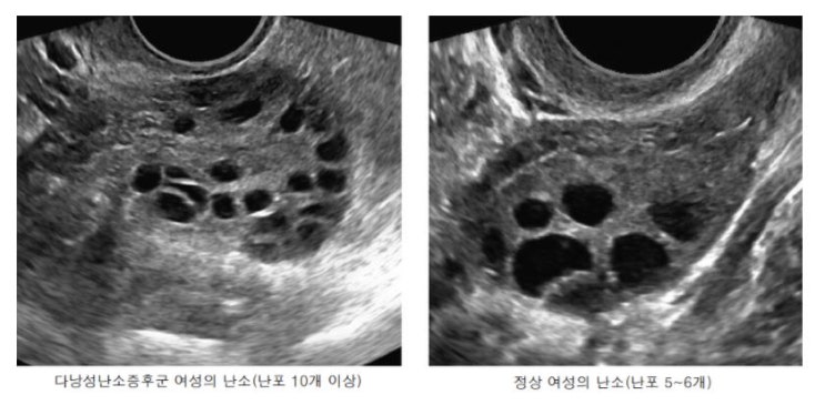  나도 혹시 조기 폐경 ? 난소 나이 검사, 난소 기능 개선하려면