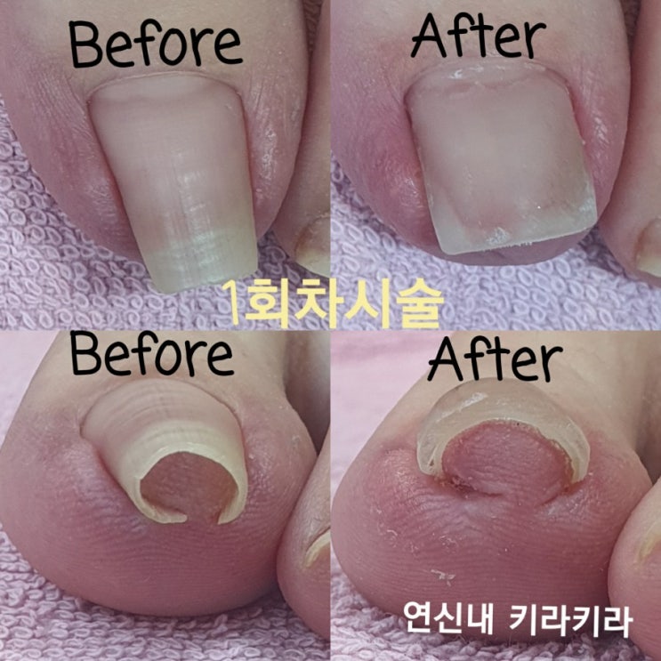  [ 은평구(연신내)네일 ]은평구내성발톱 내성발톱 해결은 키라키라에서!!!그랩테크닉 (Grap Technic)