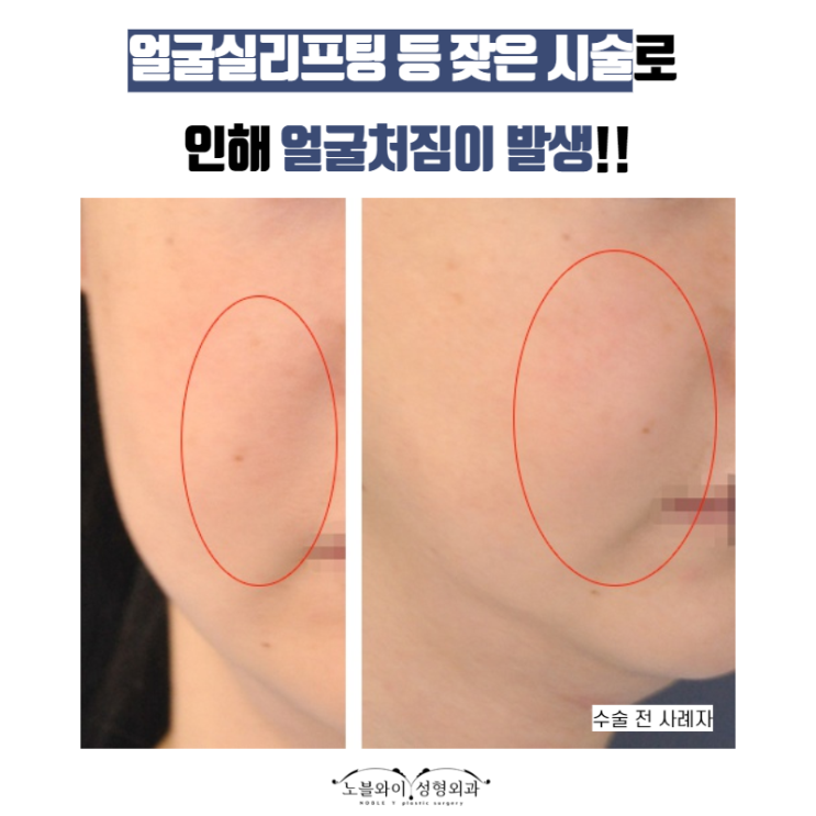  얼굴거상술 이물질제거도 같이