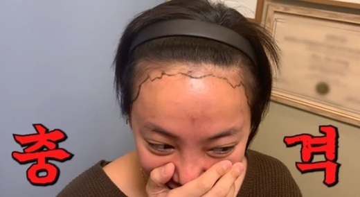 미르 모발이식 리터치, 500모 진행..탈모 저리가라!!(+누나 고은아 방가네 나이 선산)