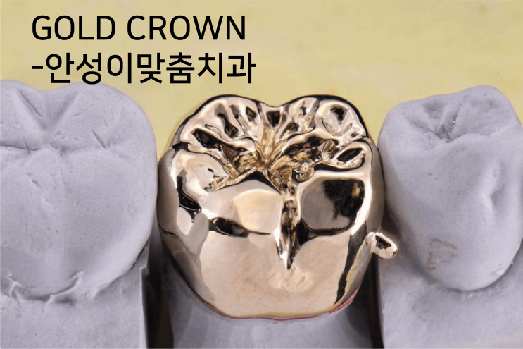  안성치과에서 확인해보는 크라운 종류 및 가격