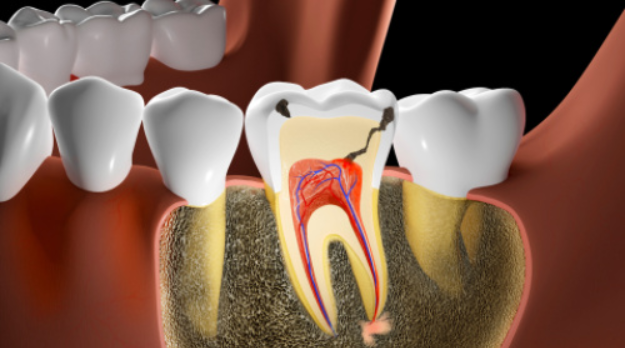 치아를 지키는 신경치료