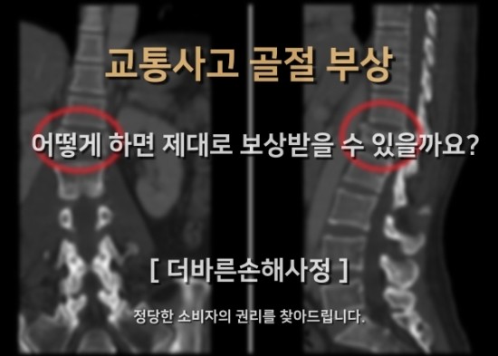  [인천손해사정] 교통사고 골절부상 보상금 제대로 받기