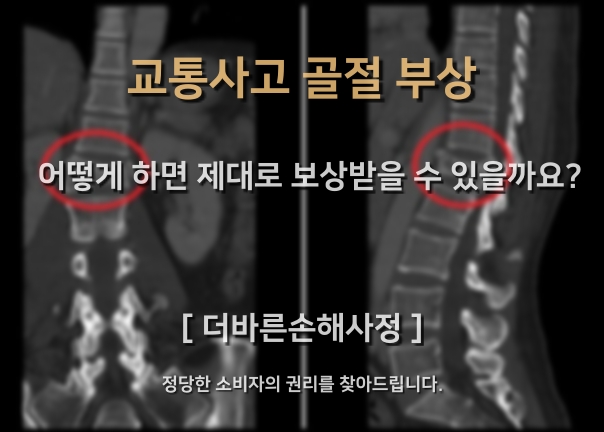  교통사고 골절 부상 제대로 보상받기 - 인천손해사정