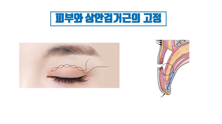  쌍꺼풀 풀릴 수 있어서 쌍수 후 눈 비비지 말라는 거예요.
