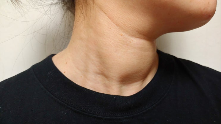  갑상선항진증 투병(?)일지(증상,검사,치료,좋은음식)