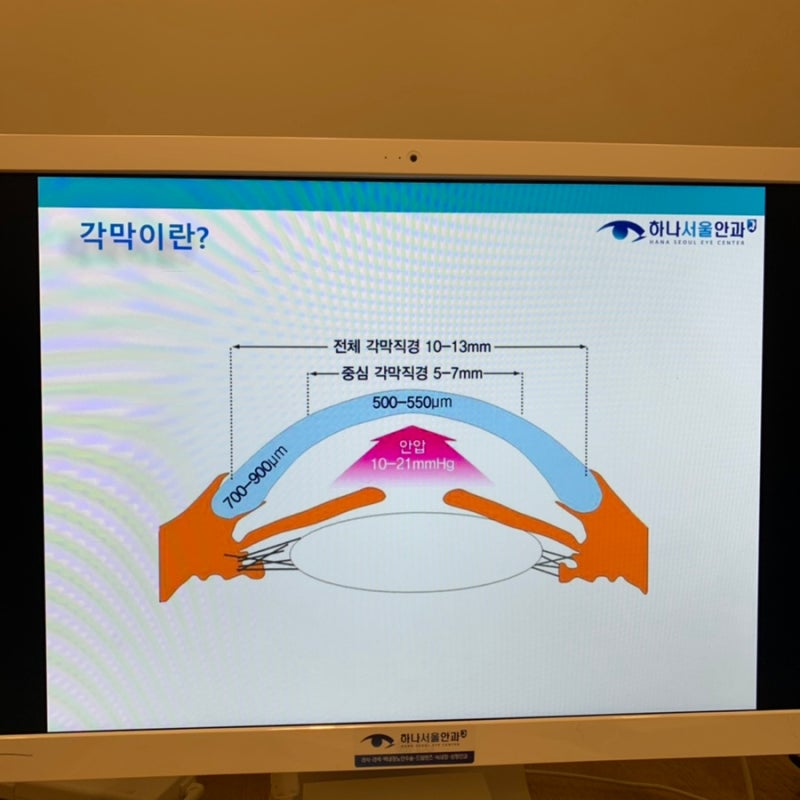 부천 하나서울안과에서 라섹수술을 해온 솔직한 검사부터 당일 리뷰(검사, 비용, 통증, 난시교정) 1