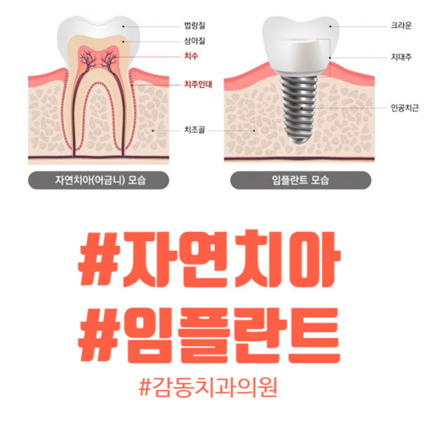 당감동치과 자연치아와 임플란트의 비교