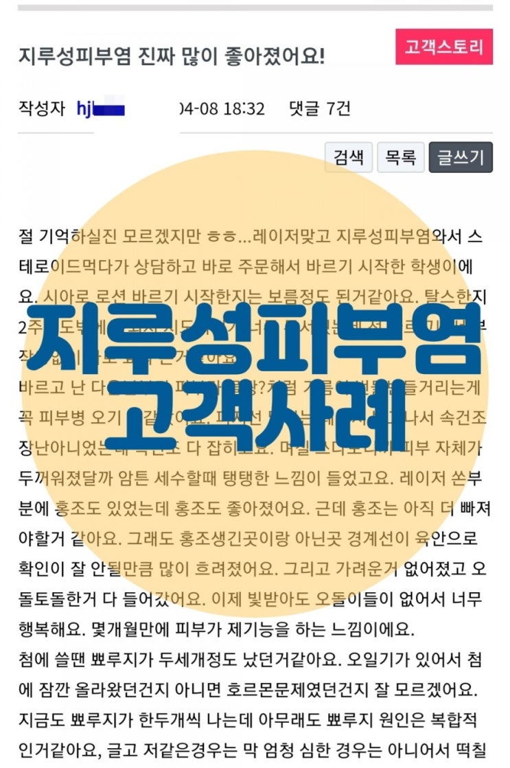  지루성피부염 진짜 많이 좋아졌어요!