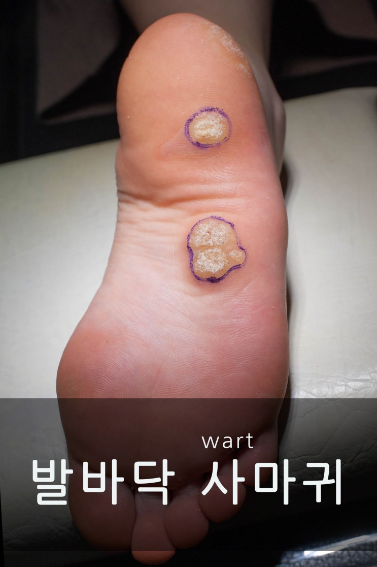  발바닥 사마귀 제거 '아프다고 티눈이 아니에요'