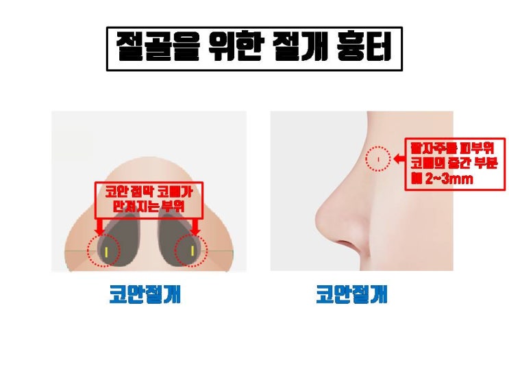  코수술 후 얼굴의 이 부위들 외에 코성형 흉터가 생겼다면 뭔가 잘 못 된 것!!!