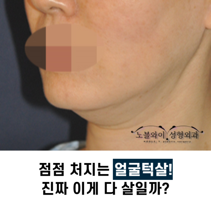 얼굴턱살처짐 왜 이중턱수술로 해야돼