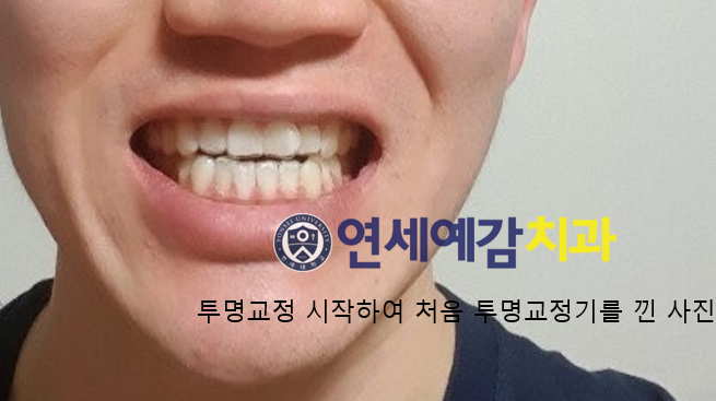  서울역 치과 투명교정 실제사례,비용가격 알아볼까요?
