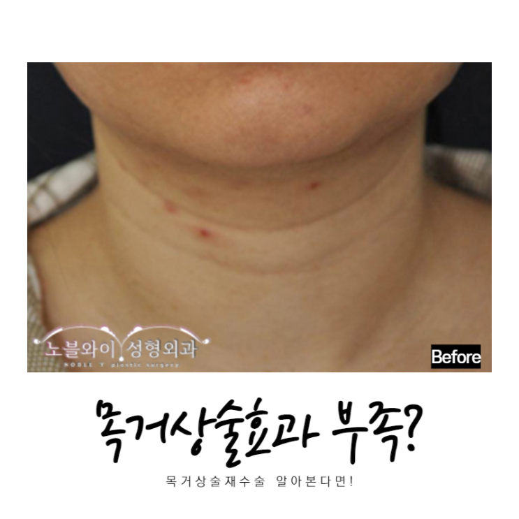  목거상술효과 부족하다면 목거상술재수술
