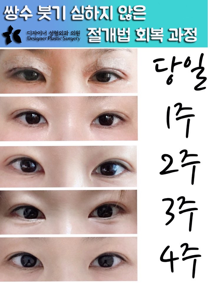누구나 알고 있어야 할 쌍수 붓기 짝짝이 원인과 해결법 : 네이버 블로그 누구나 알고 있어야 할 쌍수 붓기 짝짝이 원인과 해결법 : 네이버 블로그