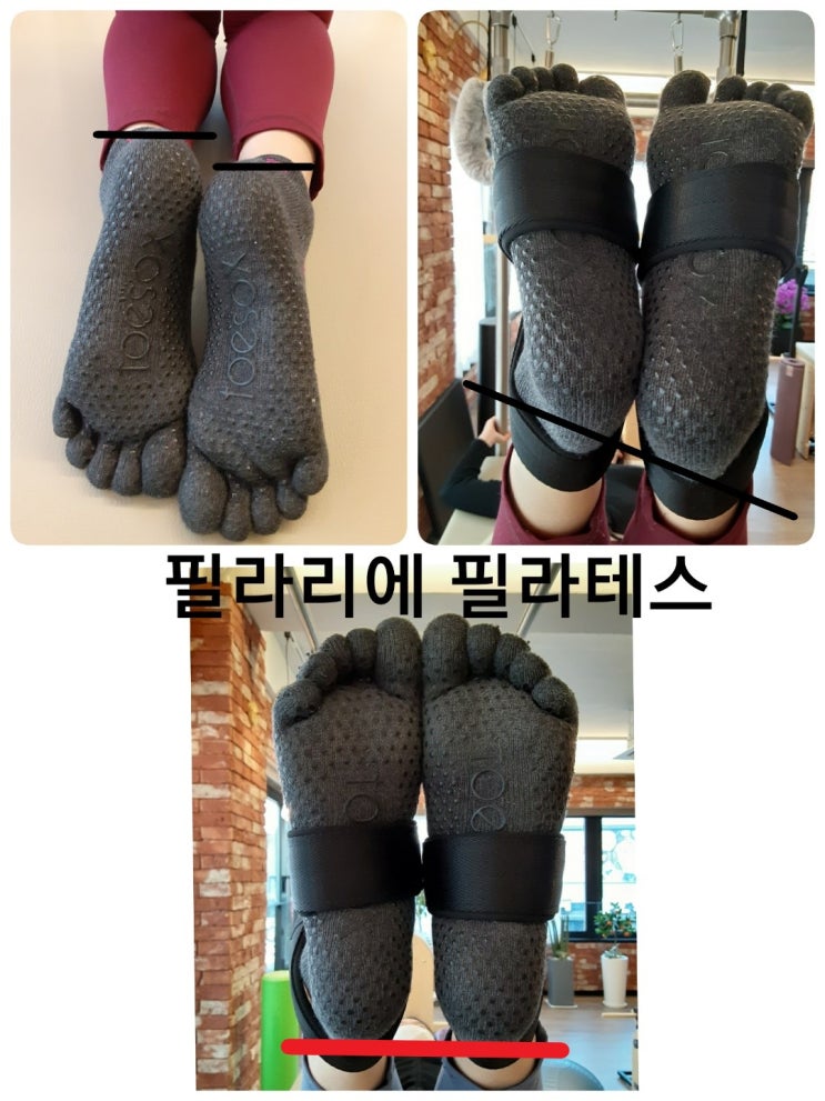  [이수역체형교정]다리길이차이 와 발과 발목 근육불균형
