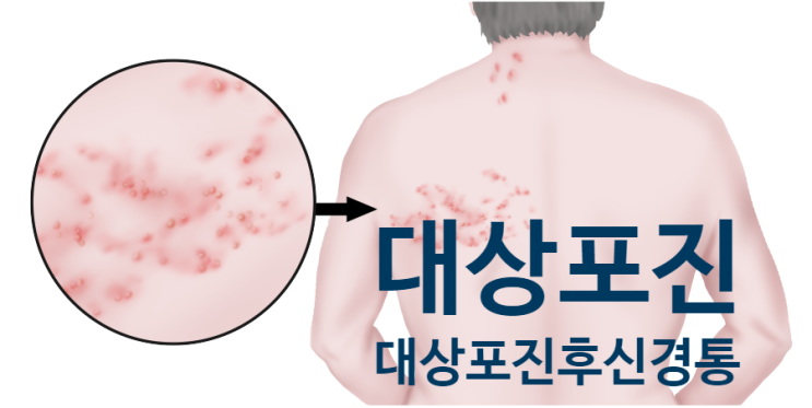 안양 대상포진 - 칼로 쑤시고 베는 듯한 극심한 통증