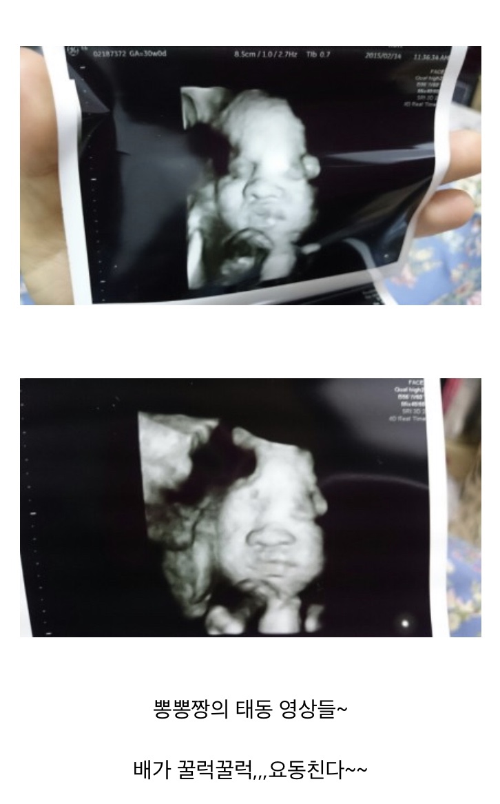  [6년 전 오늘]임신 9개월 32주 4일차 갈색혈 역아 제왕절개 가능성