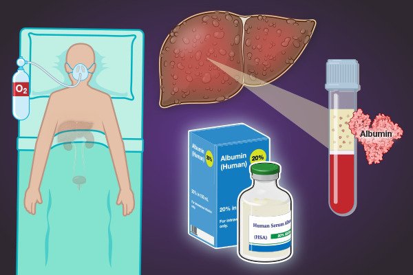 [GI] 간경화 환자 알부민 사용 - 보험, NEJM