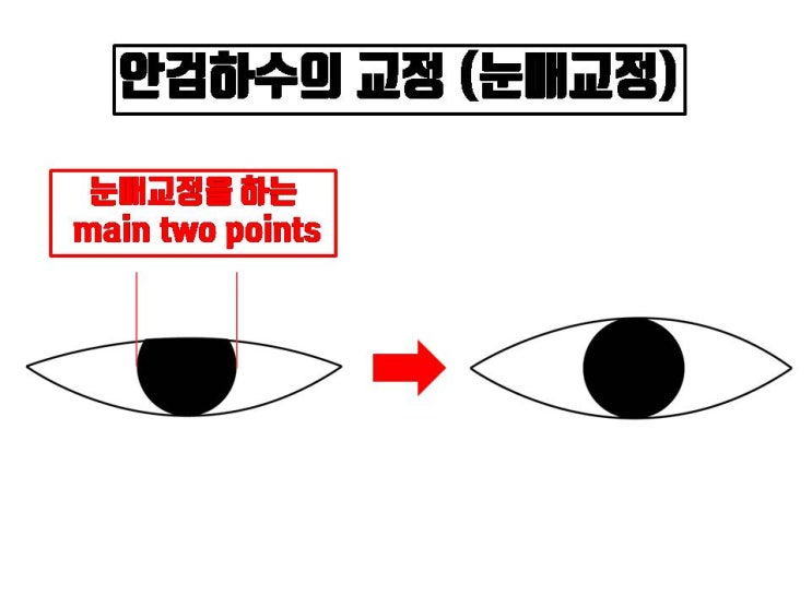  성형외과 전문의에게 눈매교정을 받는다면 눈이 찝혀 보이는 눈수술 부작용은 거의 생기지 않아요!!!