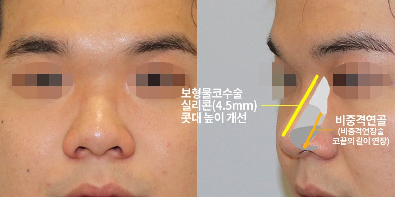 남자복코수술, 원래 오똑했던 것처럼! : 네이버 블로그 남자복코수술, 원래 오똑했던 것처럼! : 네이버 블로그