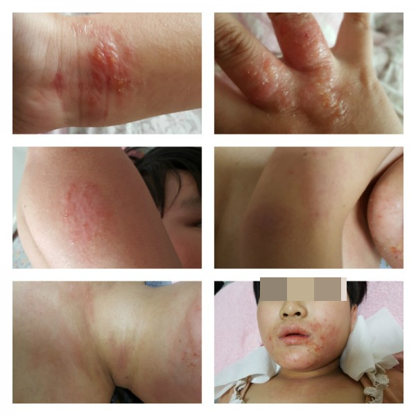  알레르기성 접촉성피부염과 농가진 극복이야기