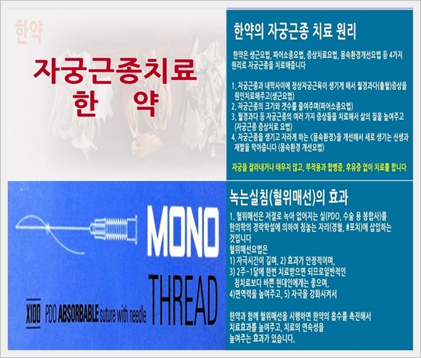  자궁근종 치료! 경희기린한의원 소개합니다