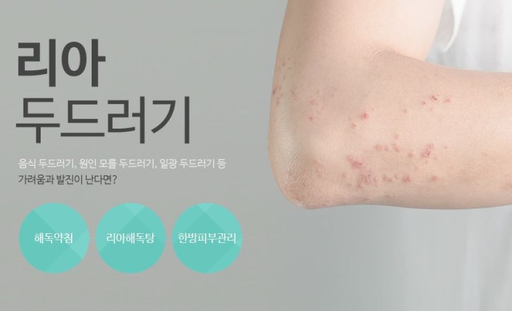  청라두드러기 치료 만성이라면 한방으로