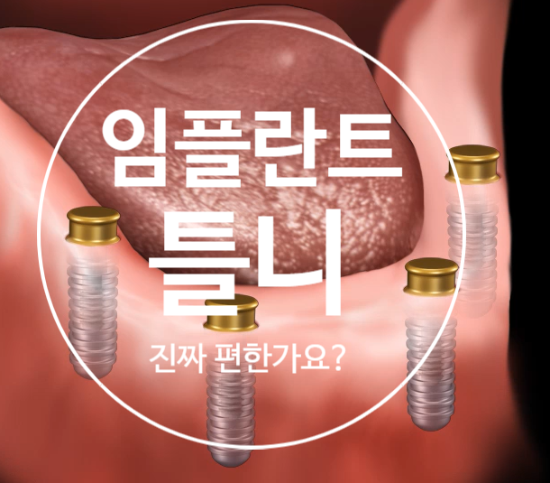  임플란트틀니 일반틀니 비교분석