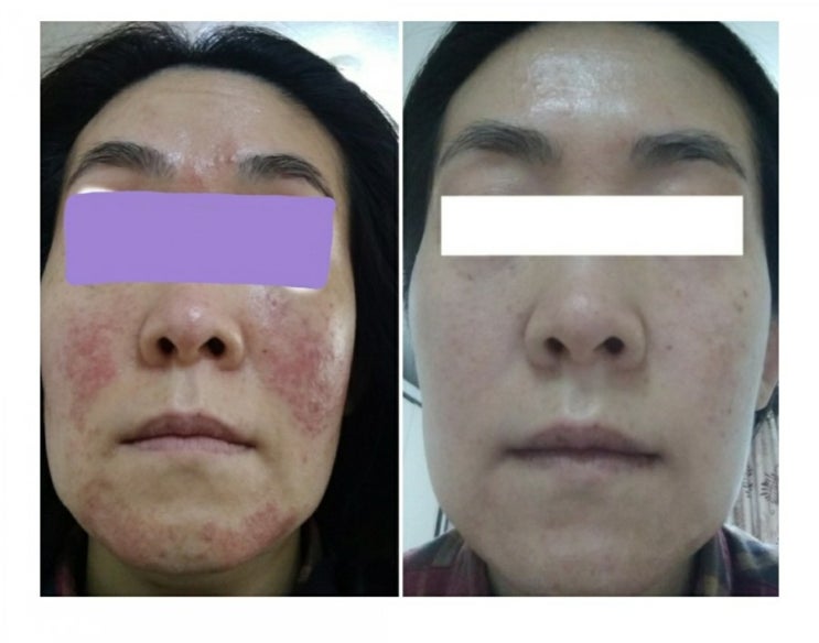  주사피부염과 홍조 고민 2달만에 해결한 방법(실제후기)