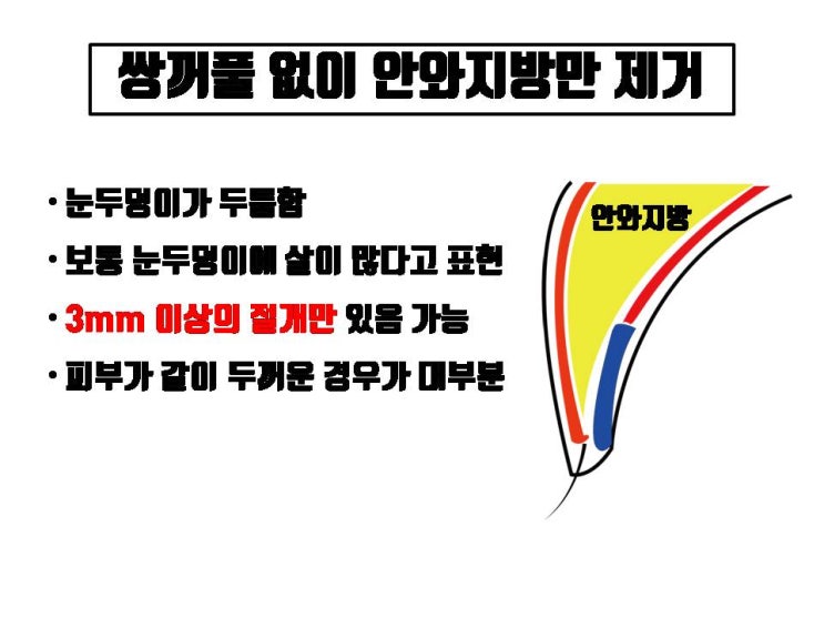  쌍수 없이 지방제거, 무쌍 눈지방제거란 실제로 가능할까?