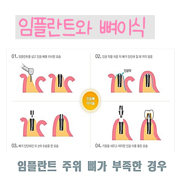  당감동치과 임플란트와 뼈이식