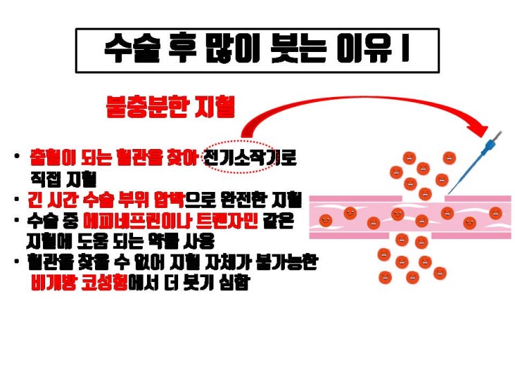  코수술 잘 하는 성형외과 전문의에게 코성형 받으면 코수술 후 붓기 훨씬 덜한 이유 5가지