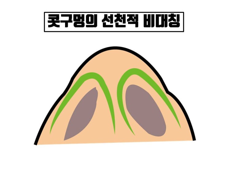  코수술 후 콧구멍 짝짝이의 원인, 비주 휘어짐을 유발하는 모든 것들이에요!!!
