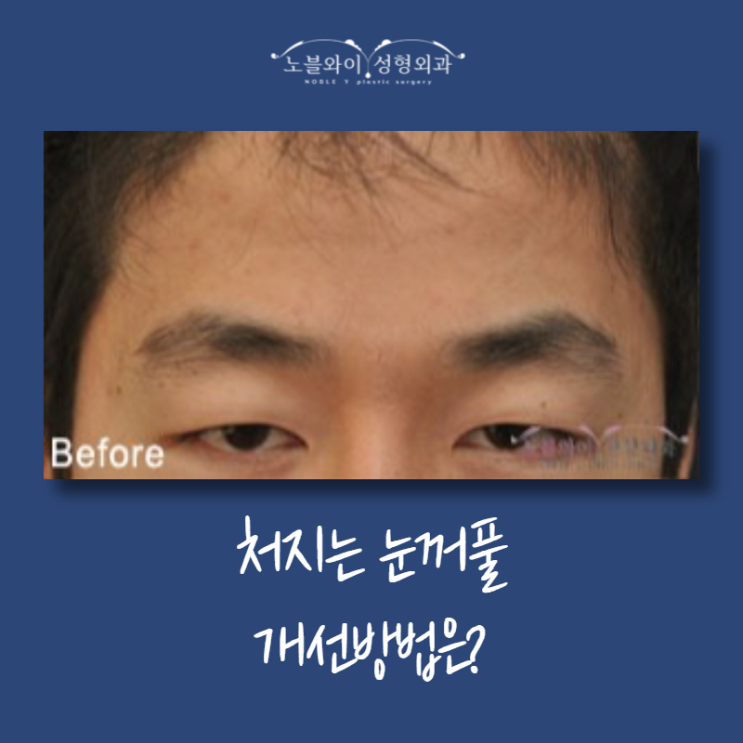  윗눈꺼풀처짐수술 미간근육이 문제