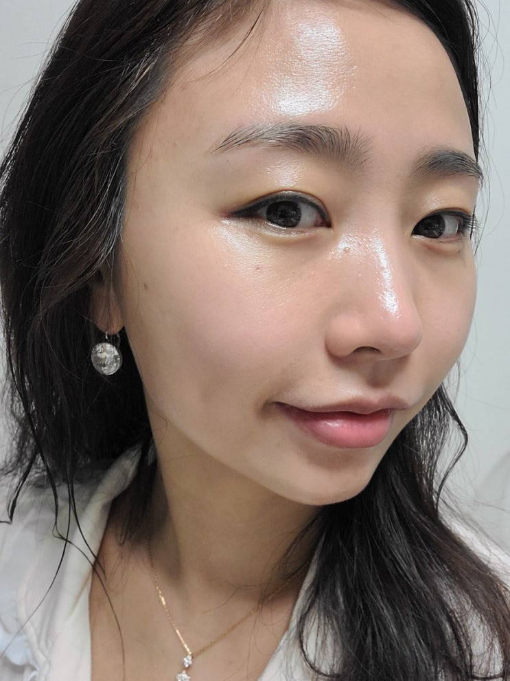  선릉역 피부과, 정품 샤넬주사 나노소프트 니들 사용 시술 후기