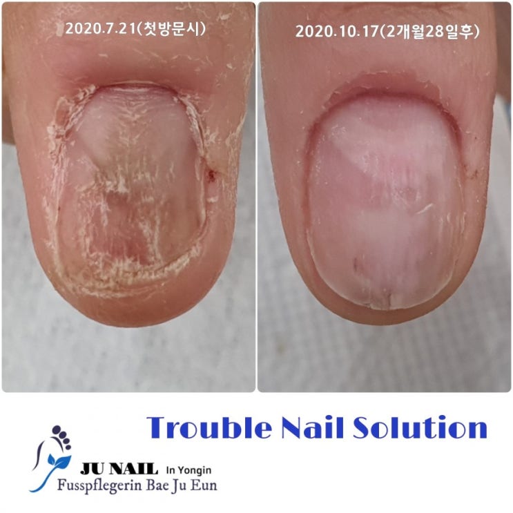 문에 끼어 다친손톱이 이상하게 변형되어 자랐어요/분당용인수원수지보정동백죽전동/주네일/무좀파고드는내향성발톱손톱변형전문네일살롱 문에 끼어 다친손톱이 이상하게 변형되어 자랐어요/분당용인수원수지보정동백죽전동/주네일/무좀파고드는내향성발톱손톱변형전문네일살롱