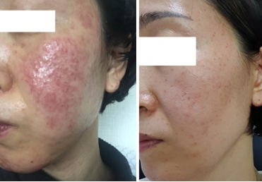  시아로와 함께 한 7개월~ 얼굴 주사 후기