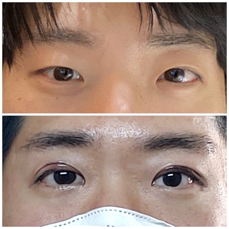  남자 쌍수 비절개 후기 당일 +  2일차 순조롭구요