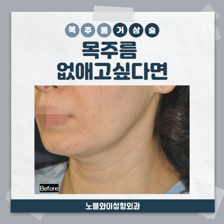  목주름거상술 가로, 세로목주름, 선천적목주름 등 개선가능